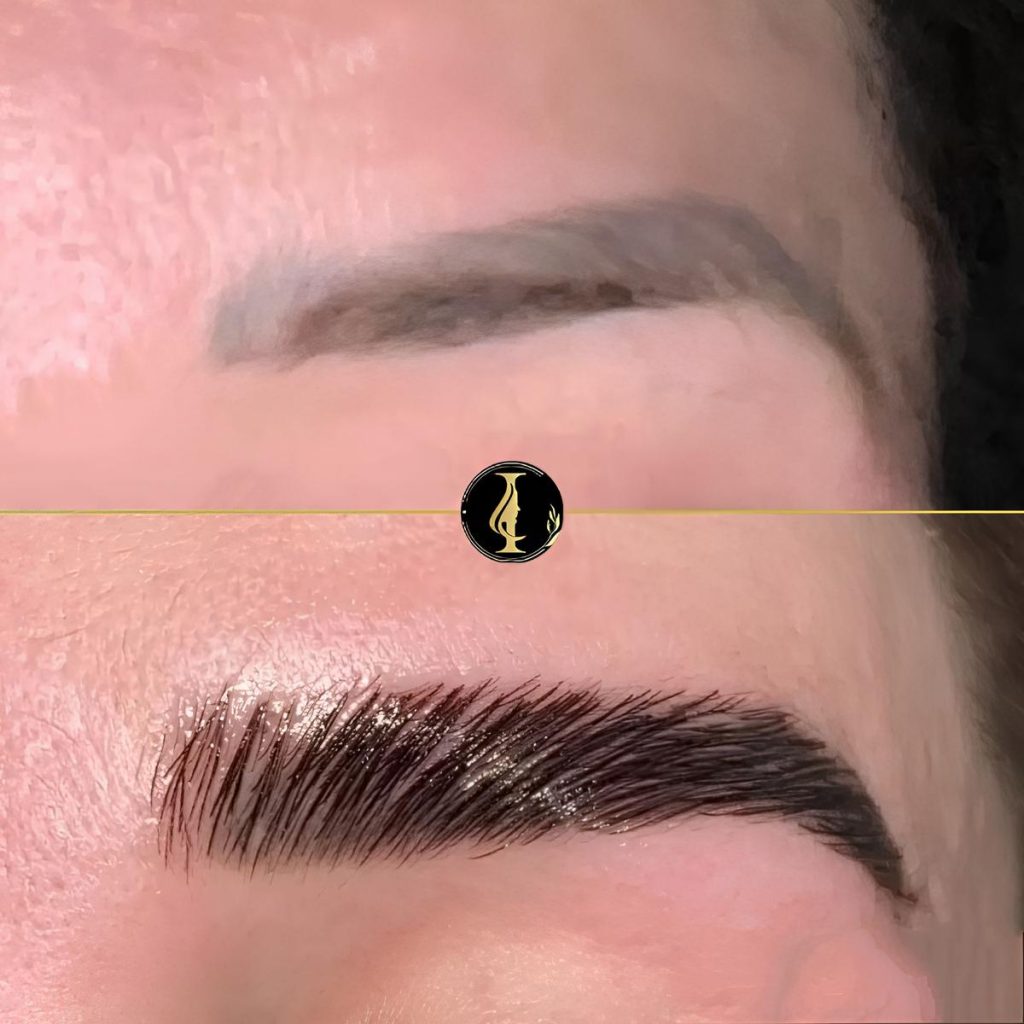 Revitalize Your Look: Eyebrow Implant Makeovers at International Hair Clinic