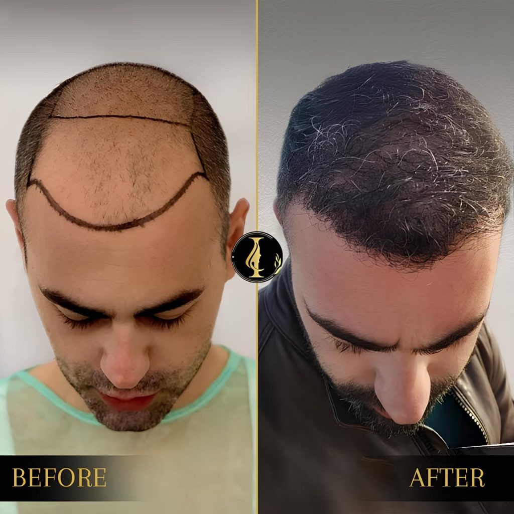 Transform Your Look with Hair Transplantation: Our Expert Guide