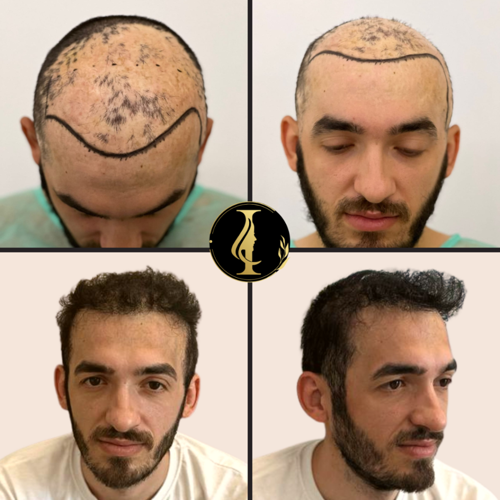 Trapianto di Capelli