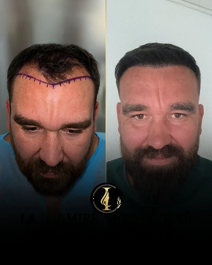 hair transplant benefits