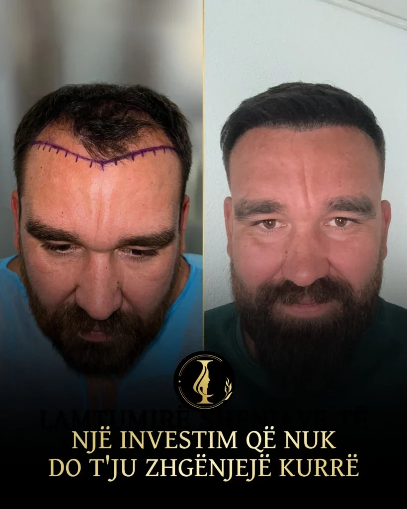 përfitimet e transplantit të flokëve