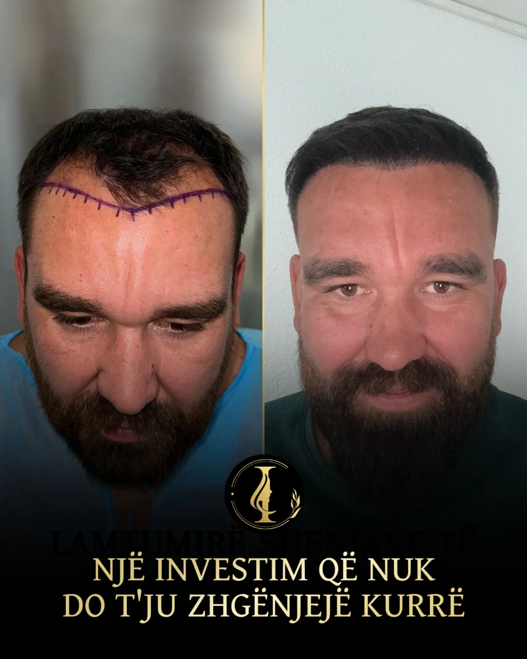 përfitimet e transplantit të flokëve