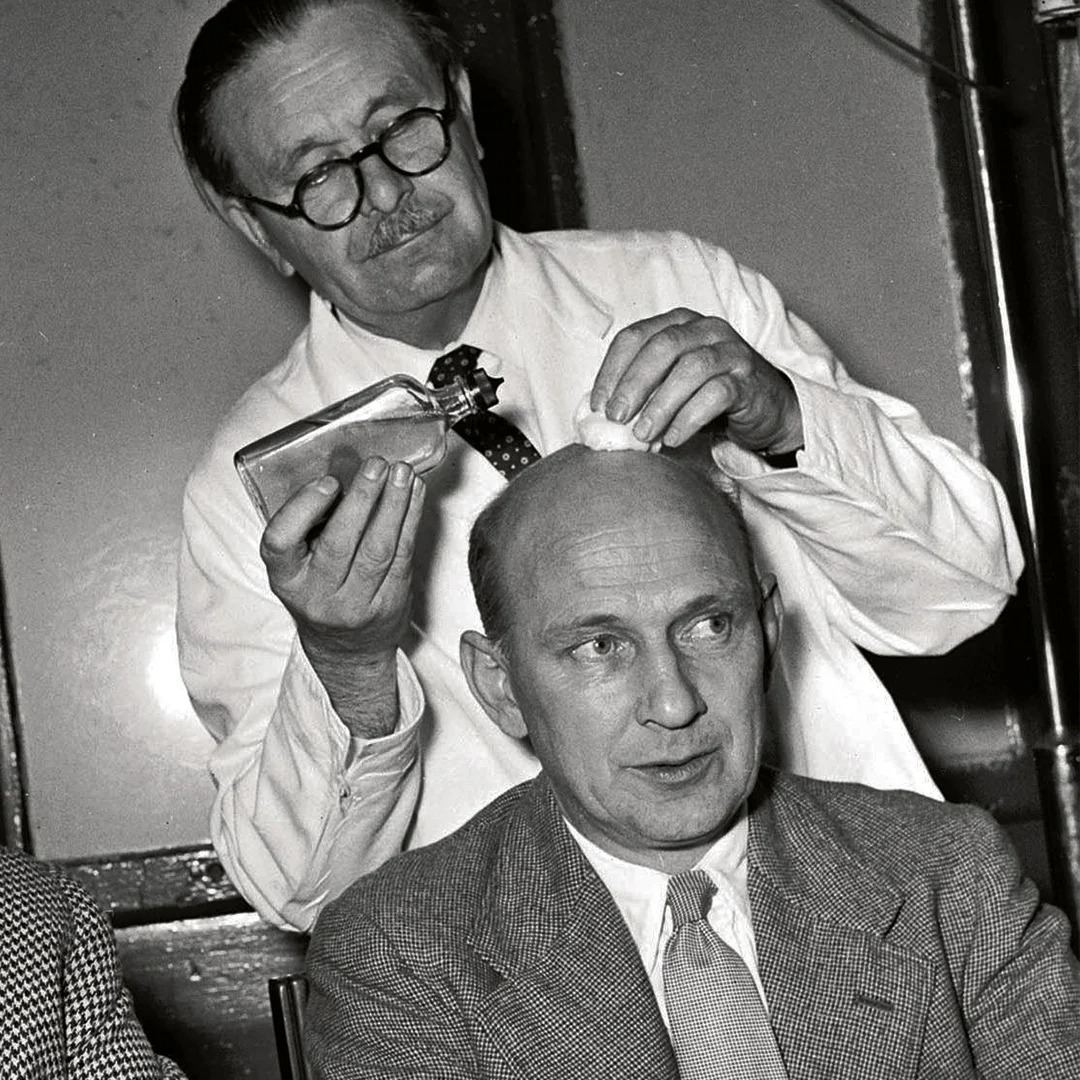 History of Hair Transplantation